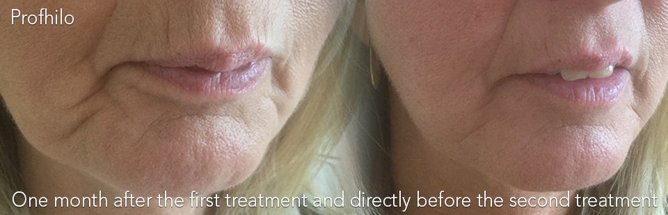 Have you heard about Profhilo?