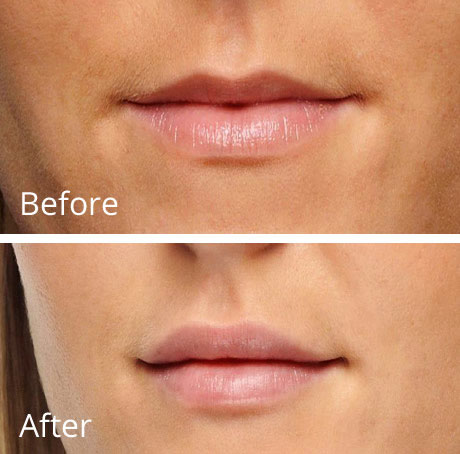 Lip Enhancements before and after image